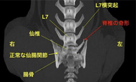 【CT、腰部背断像、骨条件】