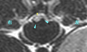 【MRI、T11-12横断像、T2強調画像】