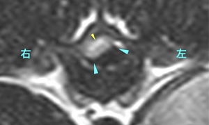 【MRI、T11椎体中央横断像、T2強調画像】