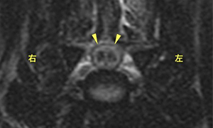 【MRI、C5-6横断像、T2強調画像】