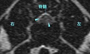 【MRI、T13-L1横断像、T2強調画像】
