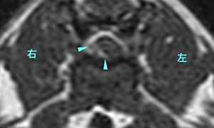 【MRI、T13-L1横断像、造影T1強調画像】