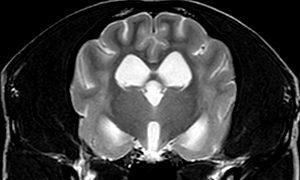 【MRI、横断像、T2強調画像（脳圧正常時）】
