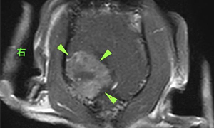 【MRI、背断像、造影T1強調画像】