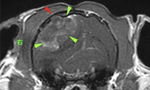 【MRI、横断像、造影T1強調画像】