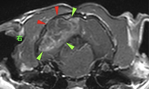 【MRI、横断像、造影T1強調画像】