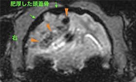 【MRI、横断像、T2*強調画像】