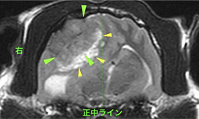 【MRI、横断像、T2強調画像】