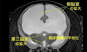 【MRI、横断像、T2強調画像】