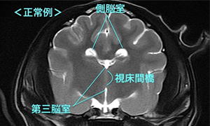 【MRI、横断像（正常）、T2強調画像】