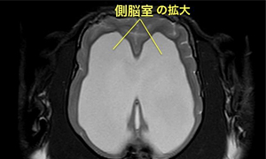 【MRI、背断像、T2強調画像】