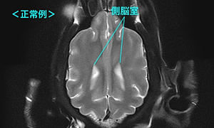 【MRI、背断像（正常）、T2強調画像】