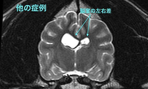 【MRI、横断像（他の症例）、T2強調画像】