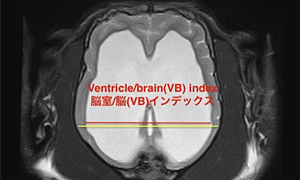 【MRI、背断像（本症例）、T2強調画像】