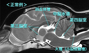 【MRI、矢状断像（正常）、T2強調画像】