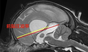 【MRI、矢状断像、T2強調画像】