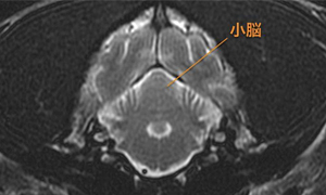 【MRI、小脳横断像、T2強調画像】