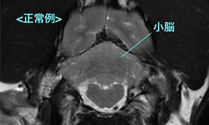 【MRI、小脳横断像（正常例）、T2強調画像】