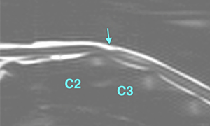 【MRI、病変部の横断像、MRミエログラフィー】