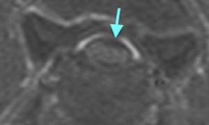 【MRI、病変部横断像、T1強調画像】