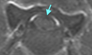 【MRI、病変部横断像、造影T1強調画像】