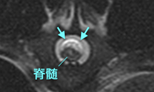 【MRI、病変部横断像、T2強調画像】
