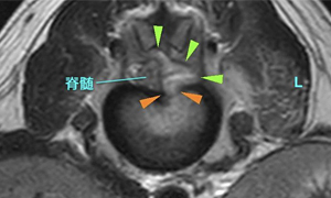【MRI、L1-2横断像、T2強調画像】
