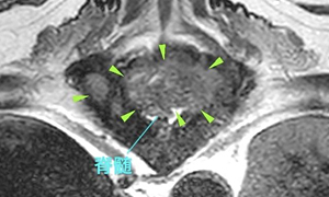 【MRI、病変部の横断像、T2強調画像】