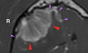 【MRI、横断像、造影T1強調画像】