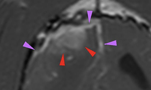 【MRI、横断像、造影T1強調画像】