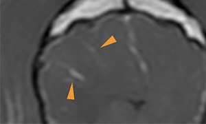 【MRI、横断像、造影T1強調画像】