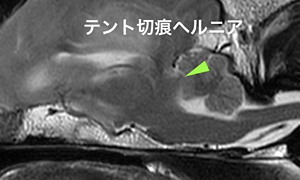 【MRI、矢状断像、T2強調画像】