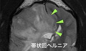 【MRI、横断像、T2強調画像】