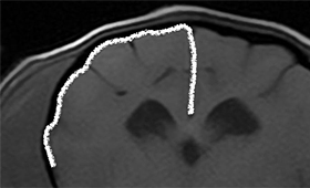 【pachymeningeal enhancement】