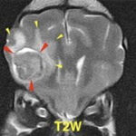 【MRI、横断像、T2強調画像】