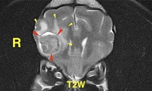 【MRI、横断像、T2強調画像】