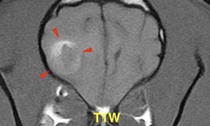 【MRI、横断像、T1強調画像】