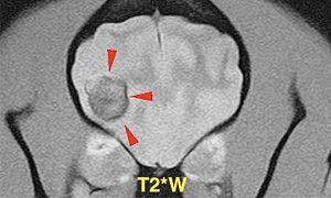 【MRI、横断像、T2*強調画像】