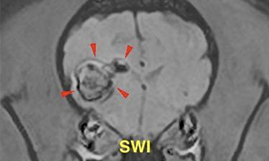 【MRI、横断像、SWI】