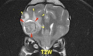 【MRI、横断像、T2強調画像】