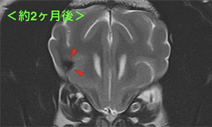 【MRI、横断像、T2強調画像】