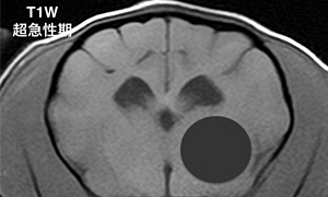 【超急性期、T1強調画像】
