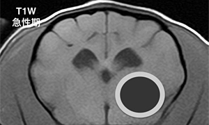【急性期、T1強調画像】