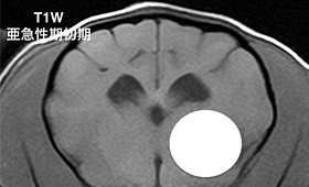 【亜急性期初期、T1強調画像】