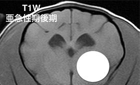 【亜急性期後期、T1強調画像】