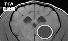 【慢性期、T1強調画像】