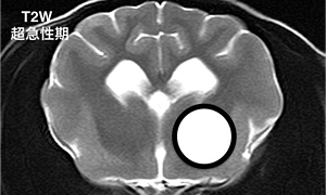 【超急性期、T2強調画像】