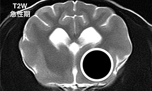 【急性期、T2強調画像】