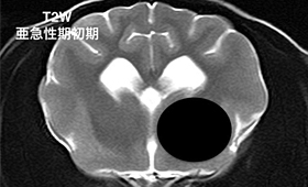 【亜急性期初期、T2強調画像】