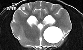 【亜急性期後期、T2強調画像】